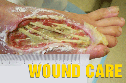 wound care