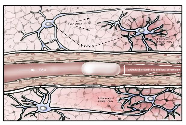 Air bubble blocking blood flow in brain. Image by Dr. Monte Anderson